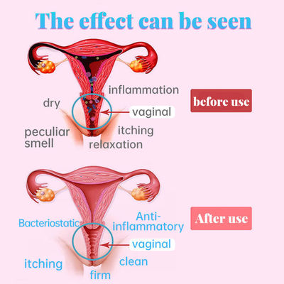 Vaginalpflegeprodukte für die Gesundheit von Frauen Funktion Verengung der Vagina Haltbarkeit 2 Jahre